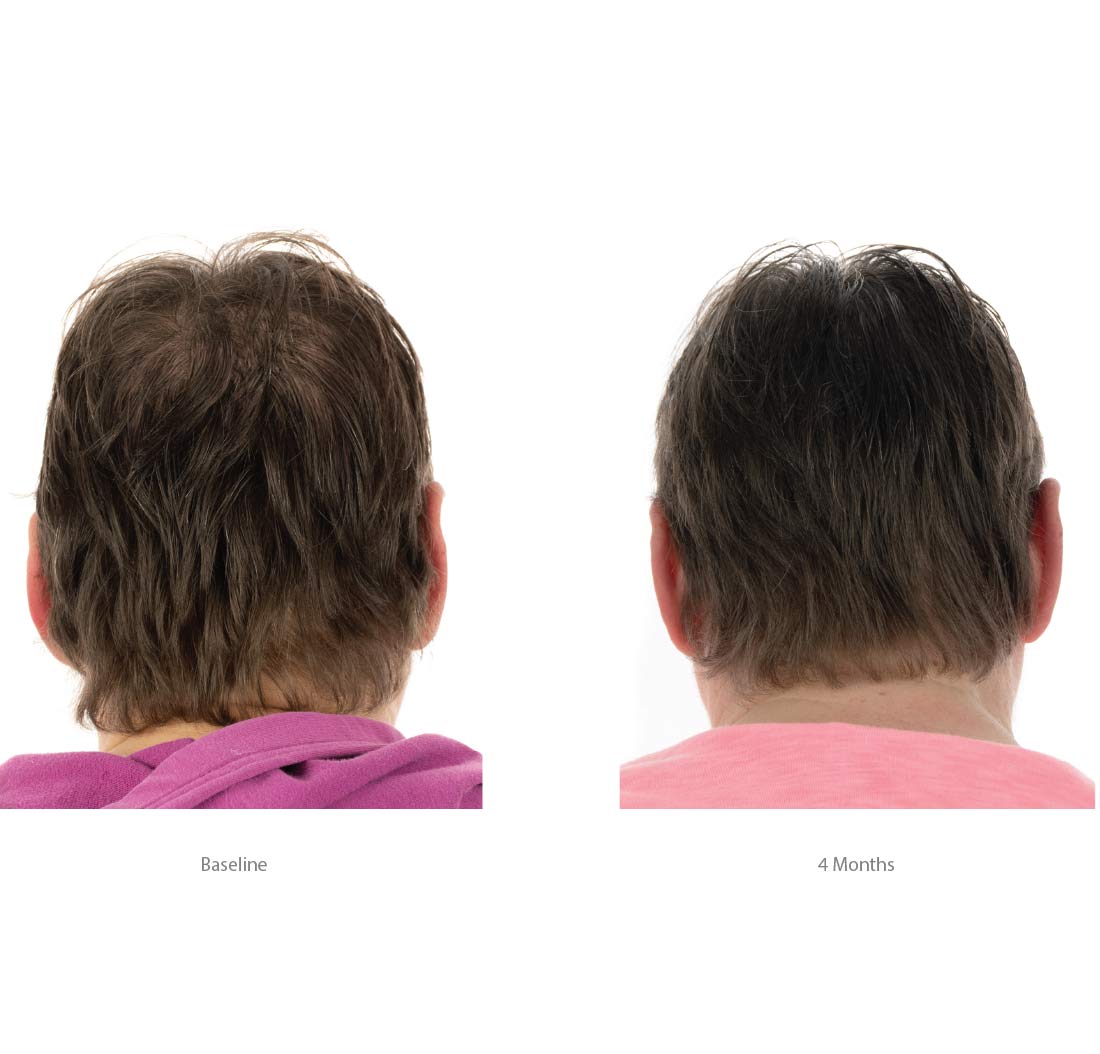 FOLIGAIN® Triple Action Conditioner For Thinning Hair For Women with 2% TRIOXIDIL®
